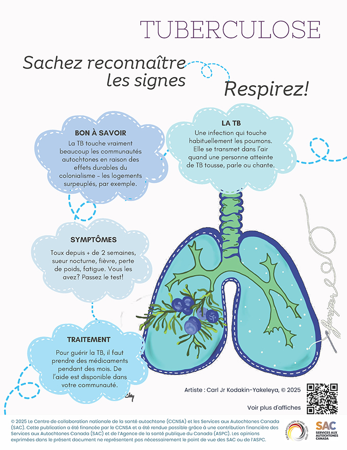 Learning gallery: Tuberculosis (TB) - Juniper on the lungs